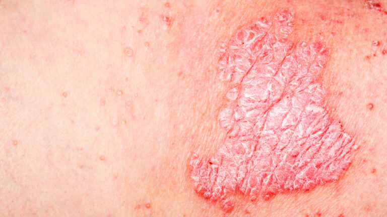 Deutlich gerötete und schuppende Hautstelle bei Psoriasis